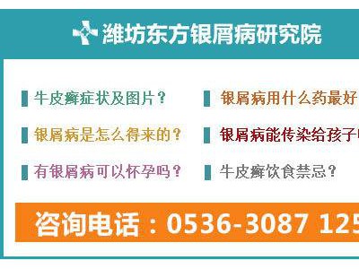 潍坊牛皮癣有几个